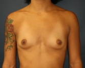 Feel Beautiful - Breast Augmentation San Diego Case 77 - Before Photo